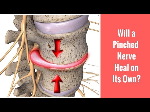 Will a Pinched Nerve Heal on Its Own? Discussed by St. Joseph, MI Chiropractor