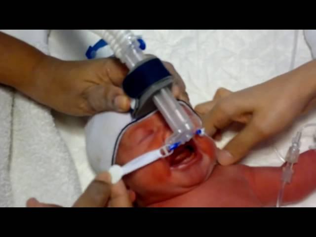 Attachment of bubble Nasal CPAP on a newborn