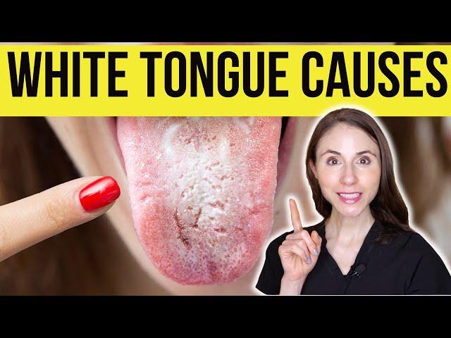 What Causes White Tongue?