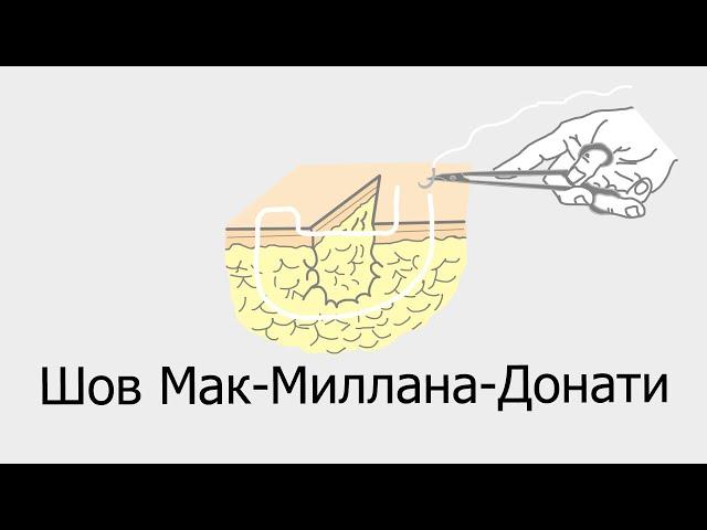 Шов Мак Миллана Донати