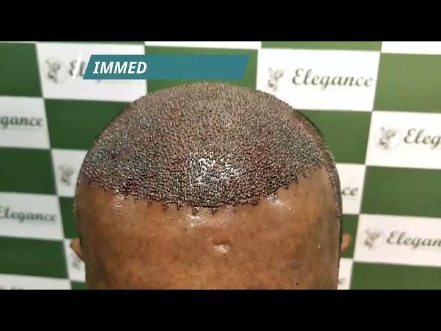 FUE Method of Hair Transplant| Hair Fall Treatment Adajan, Vesu, Kim, Surat, Navsari, Vapi, Gujarat