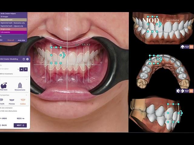 exocad no prep veneers in under 5 minutes using the patients natural teeth as the library