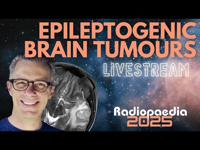 Epileptogenic brain tumours with Frank Gaillard