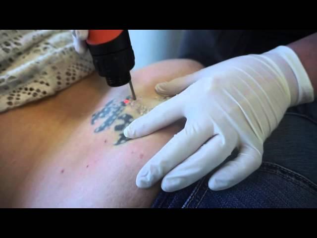 See Her Getting Laser Tattoo Removal Treatment by Dr. Jason Emer, MD Beverly Hills, California