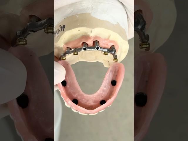 Locking onto a hybrid bar #lsk121shorts #dentist #teeth