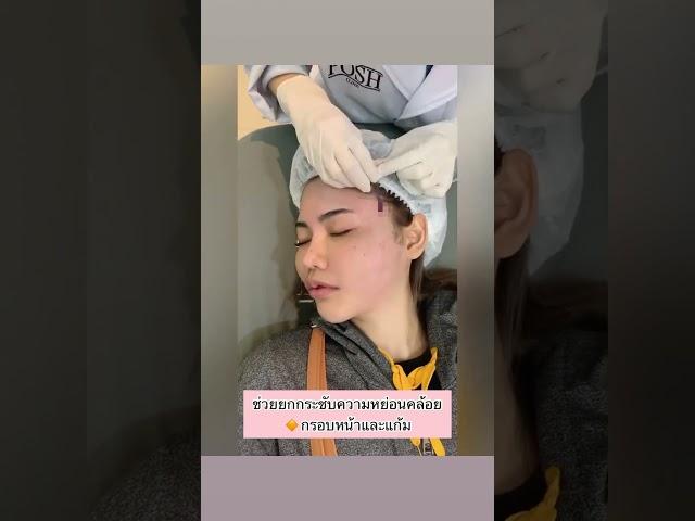 ร้อยไหมยกกระชับความหย่อนคล้อย วีเชฟช่วยให้รูปหน้าชัด เห็นผลทันทีหลังทำ