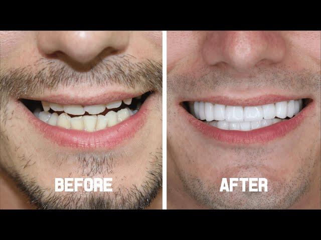 Hollywood Smile (Zirconium Crowns) - Charlie from the U.K