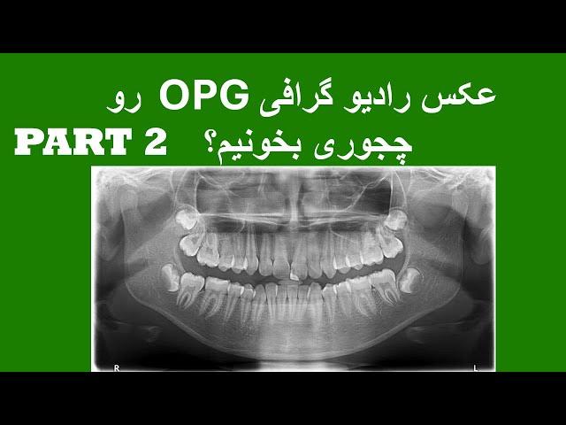 رادیو گرافی پانورامیک (اوپی جی ) رو چجوری بخونیم؟ تحلیل، تفسیر و بررسی کامل. (قسمت دوم)   OPG