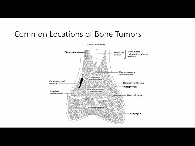 AROI WB Clinical Oncology : Bone Tumors & Soft Tissue Sarcoma