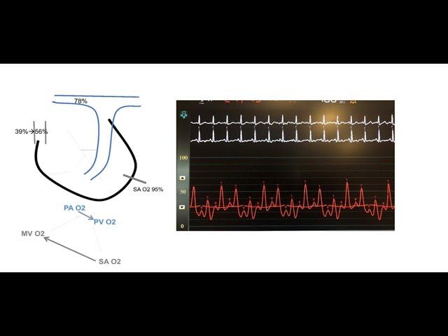 Quick assessment of cardiac shunts and quick Qp/Qs calculation- Elias Hanna, Univ of Iowa