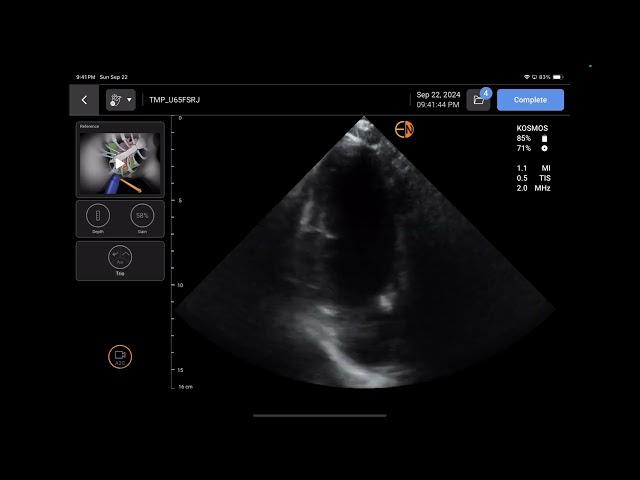 Handheld Ultrasound Review: KOSMOS by Echonous