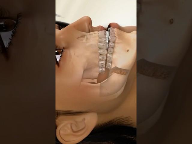 This treatment is used to correct the underbite 