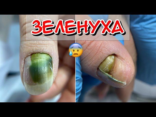 Pseudomonas aeruginosa / Sigegnoyka / Green nail / Onycholysis