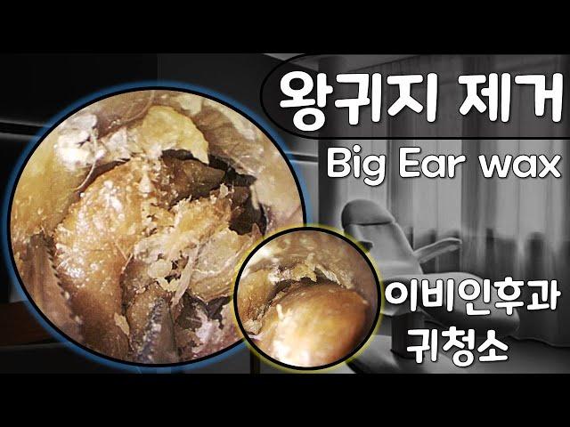 [귀팡] 왕귀지 청소 Big Ear wax removal (초고화질 HD endoscope)