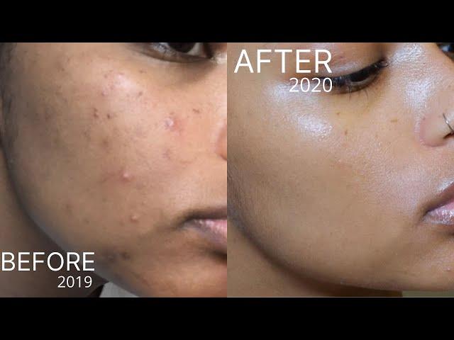 Affordable Skincare Routine for Acne Scars & Hyperpigmentation