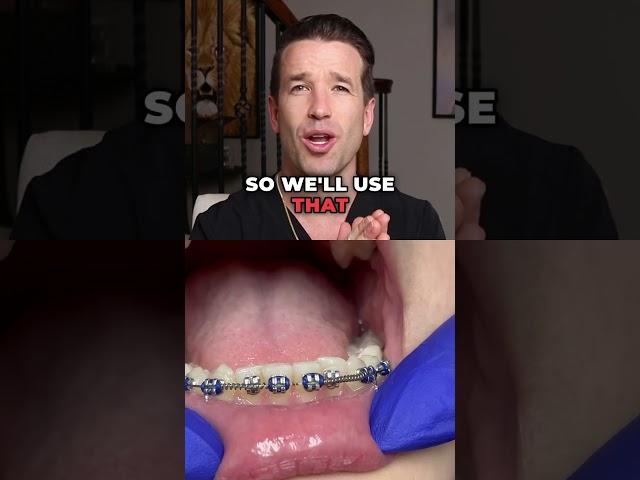 Crowded Teeth and Braces