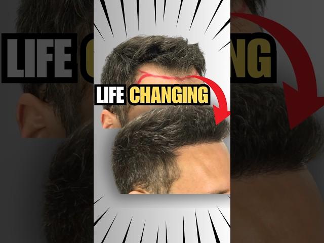 2.335 Grafts Changed His Life