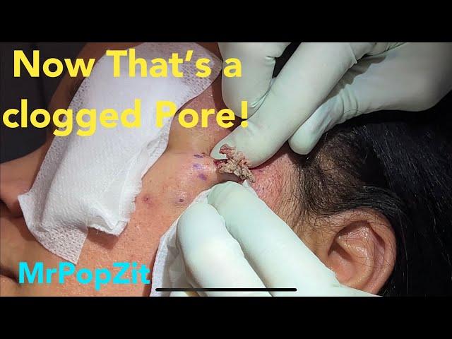 Now that’s a clogged pore! Large face bump removed and closed with running sub-cuticular stitch.