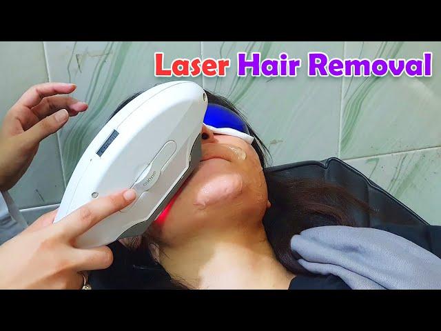 Facial Hair Removal by Laser in a Patient with Hirsutism | Permanent Hair Growth Reduction