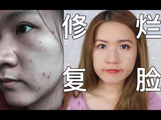 【竹子】我是怎么修复烂脸的？|精简护肤抗痘护肤经验分享，底妆卸妆保养