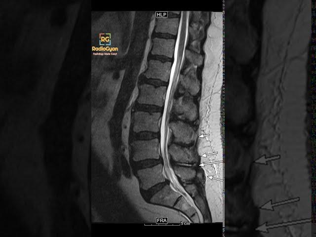 Baastrup's Disease | Radiology Board Review Case | YouTube #Shorts