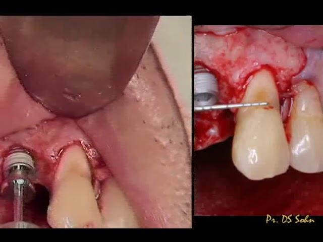 Immediate Implant Placement and Utilization of Pedicle CT graft