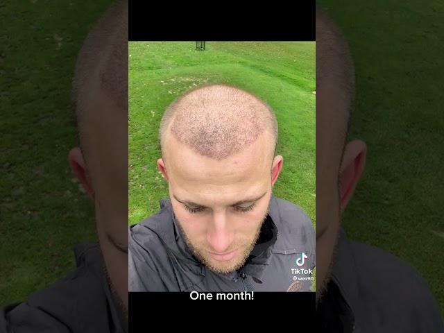 HAIR TRANSPLANT BEFORE AFTER - 11 MONTHS