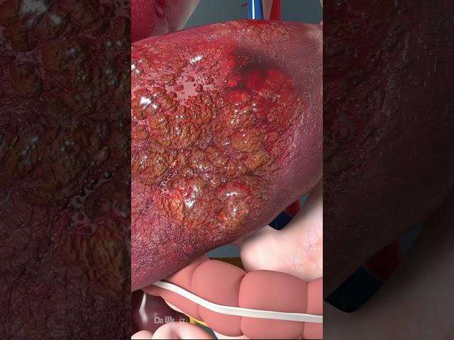 Watch What Happens To Your Body When You Use Steroids