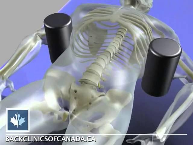 Sciatica | Spinal Decompression | Back Clinics of Canada