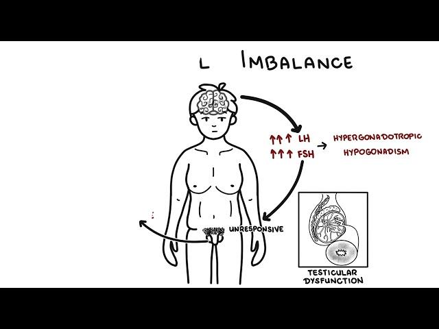 Klinefelter Syndrome - 47, XXY Karytype