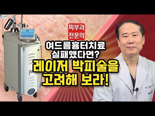 여드름 흉터 없애는 확실한 치료법!!!!-레이저 박피