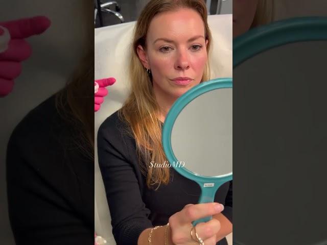 StudioMD - Cheek Augmentation Injection