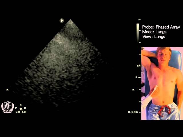 Evaluating the Lungs using Ultrasound