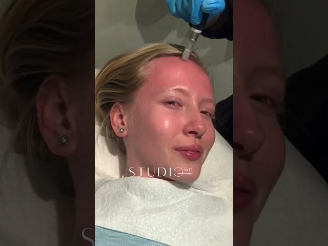 StudioMD - Vampiral Facial (PRP + Microneedling)