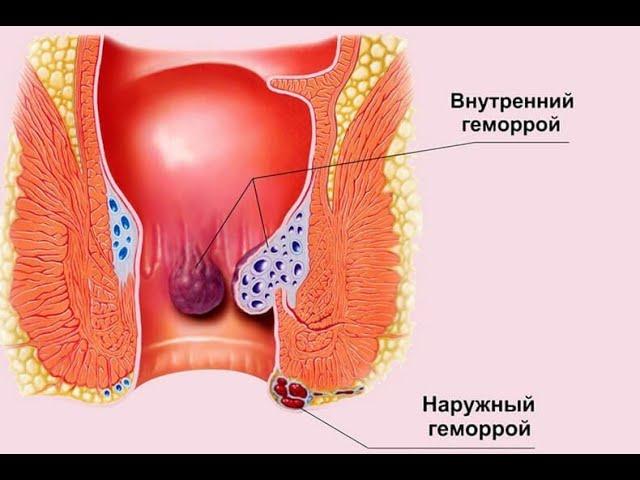 Как вылечить наружный геморрой. Метилурацил, детралекс.