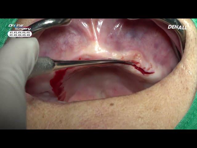 [Online Surgery] Upper full arch implant rehabilitation with Digital guided surgery