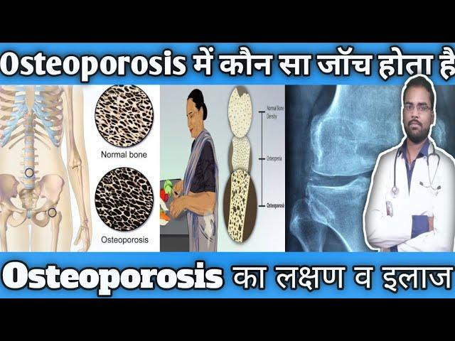 Osteoporosis का इलाज | Osteoporosis का शुरूआती लक्षण |Osteoporosis ka gharelu ilaj in Hindi |