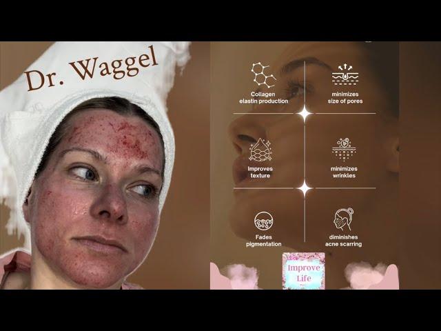 Watch Dr. Waggel Try Microneedling!