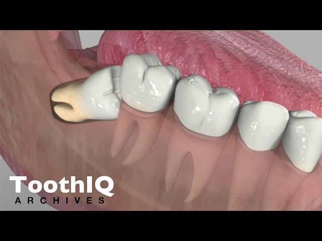 Impacted Tooth Removal