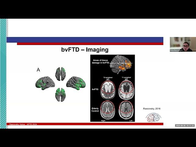 AFTD Care Partner Learning Series Webinar: Navigating Behavioral Variant FTD Symptoms