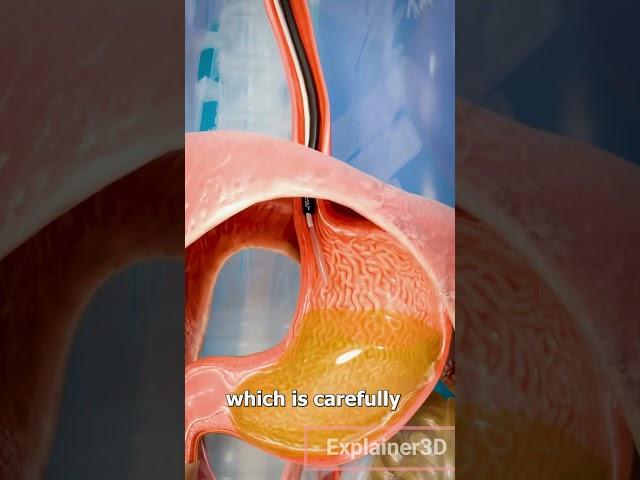 How A Gastric Balloon Works 