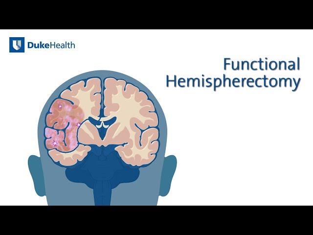 Functional Hemispherectomy | Duke Health