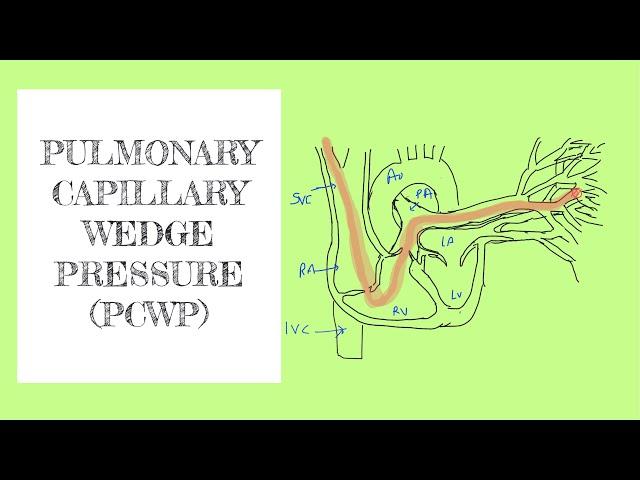 Pulmonary capillary wedge pressure (PCWP)