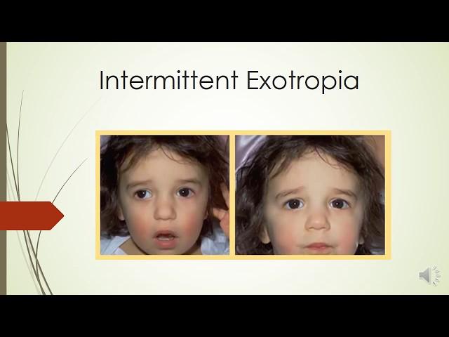 CONCOMITANT EXOTROPIA