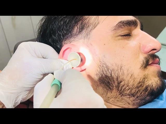 Severe Ear Wax Buildup Removed Safely – Pain, Irritation, and Hearing Damage Reversed!