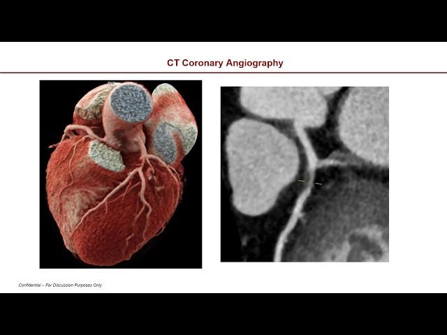 Cardiac Gating Editiing Techniques