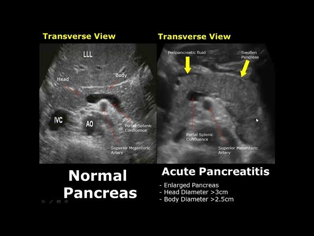 Pancreas Ultrasound Normal Vs Abnormal Image Appearances Comparison | Pancreatic Pathologies USG