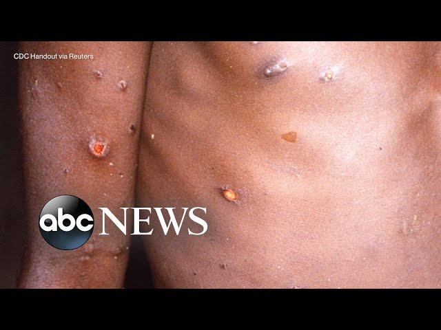 The symptoms, treatment for monkeypox l ABC News