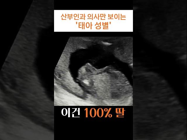 산부인과 의사는 초음파 사진만 보고 성별을 맞출 수 있을까?