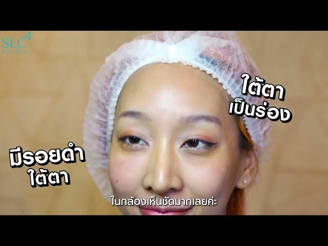 ขอบตาดำ ใต้ตาคล้ำ ให้ Glow code ช่วยจัดการ!! | SLC Clinic